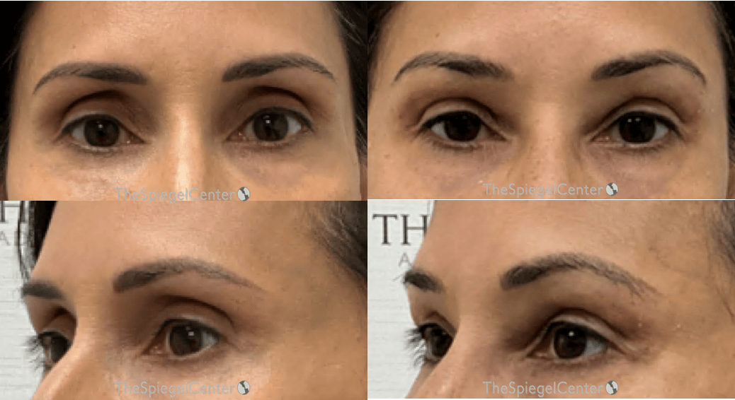 Upper Eyelid Filler Before & After Gallery - Patient 413270 - Image 1
