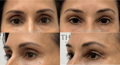 Upper Eyelid Filler Before & After Gallery - Patient 413270 - Image 1