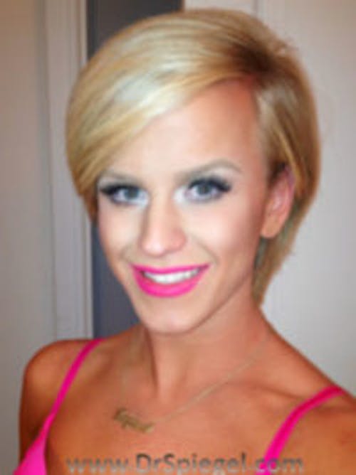 FFS Before & After Gallery - Patient 414773 - Image 1