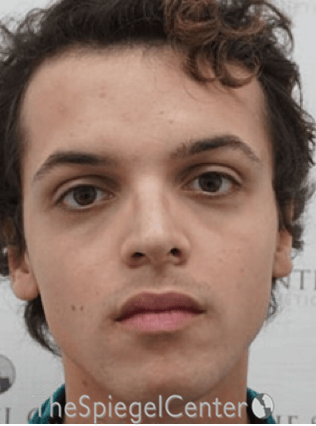 FFS Before & After Gallery - Patient 365606 - Image 1