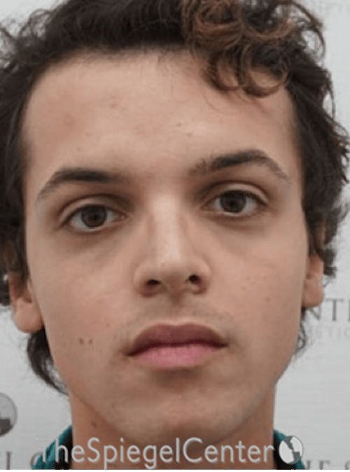 FFS Before & After Gallery - Patient 365606 - Image 1