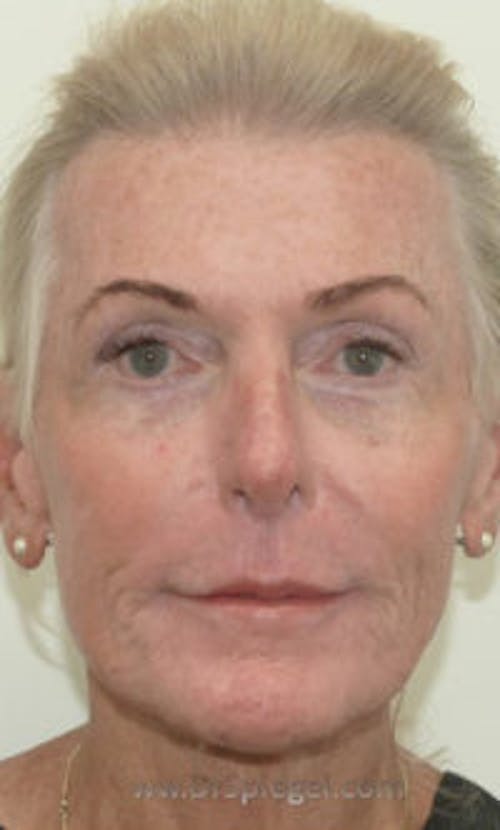 FFS Non-Surgical Feminization Before & After Gallery - Patient 909960 - Image 2