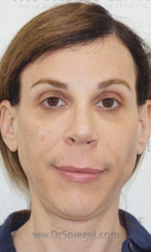 FFS Non-Surgical Feminization Before & After Gallery - Patient 350974 - Image 2