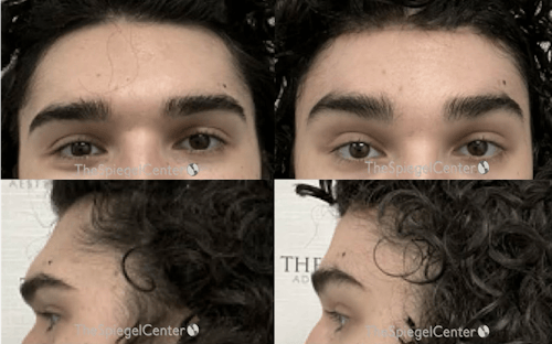 Scalp Advancement Before & After Gallery - Patient 149338 - Image 1
