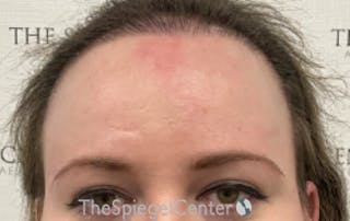 Forehead Contouring Before & After Gallery - Patient 120536 - Image 2