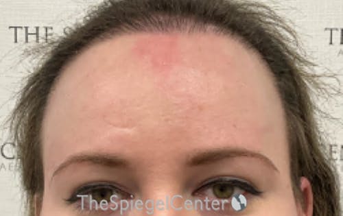 Forehead Contouring Before & After Gallery - Patient 120536 - Image 2