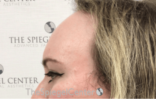 Forehead Contouring Before & After Gallery - Patient 120536 - Image 3