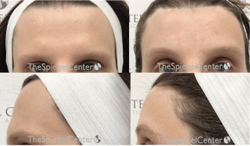Scalp Advancement Before & After Gallery - Patient 219245 - Image 1