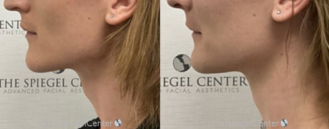 FFS Trachea Shave Before & After Gallery - Patient 126562 - Image 1