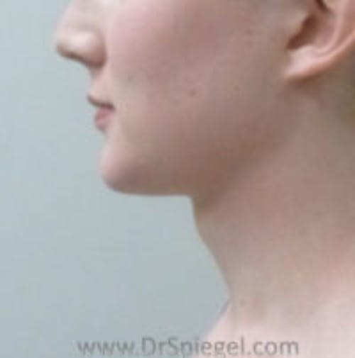 FFS Trachea Shave Before & After Gallery - Patient 108835 - Image 1