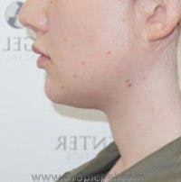 FFS Trachea Shave Before & After Gallery - Patient 108835 - Image 2