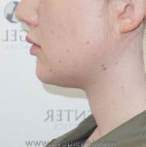 FFS Trachea Shave Before & After Gallery - Patient 108835 - Image 2