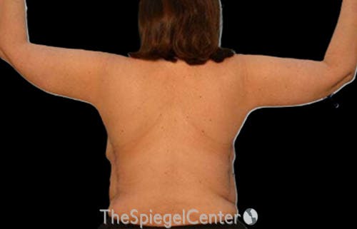 Arm Lift Before & After Gallery - Patient 233872 - Image 2