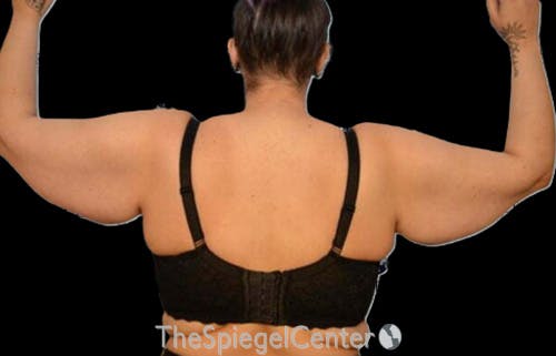 Arm Lift Before & After Gallery - Patient 394712 - Image 1