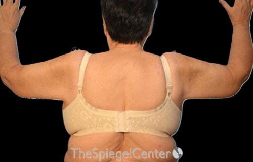 Arm Lift Before & After Gallery - Patient 210510 - Image 2