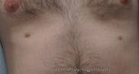 Extra Nipple Removal Before & After Gallery - Patient 228719 - Image 1