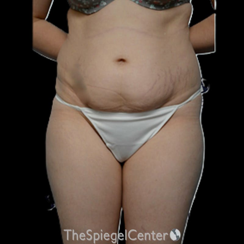 Body Contouring Before & After Gallery - Patient 230539 - Image 1