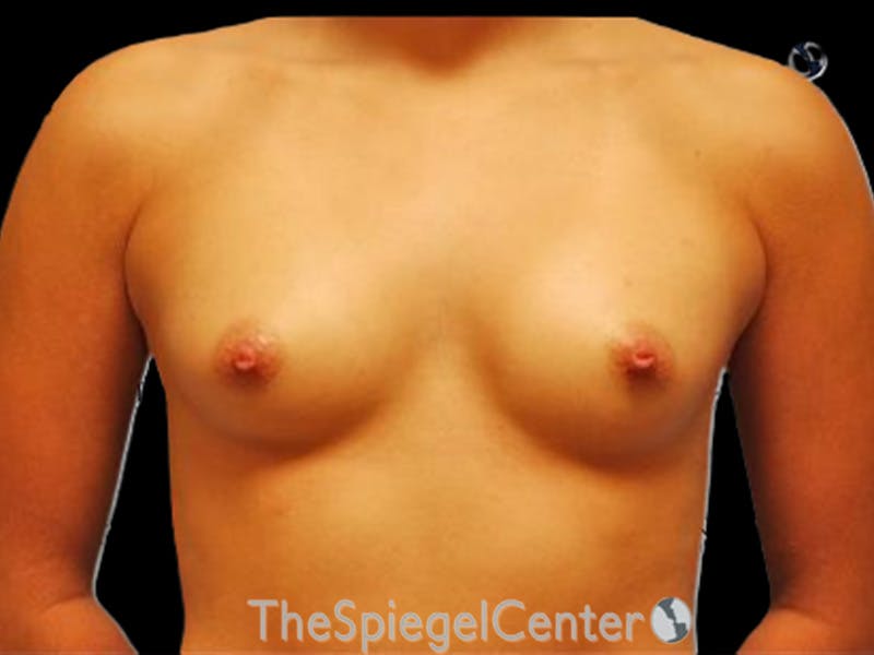 Breast Augmentation Before & After Gallery - Patient 237172 - Image 1