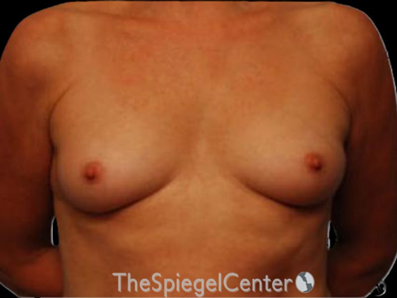 Breast Augmentation Before & After Gallery - Patient 255941 - Image 1