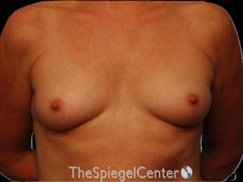 Breast Augmentation Before & After Gallery - Patient 255941 - Image 1