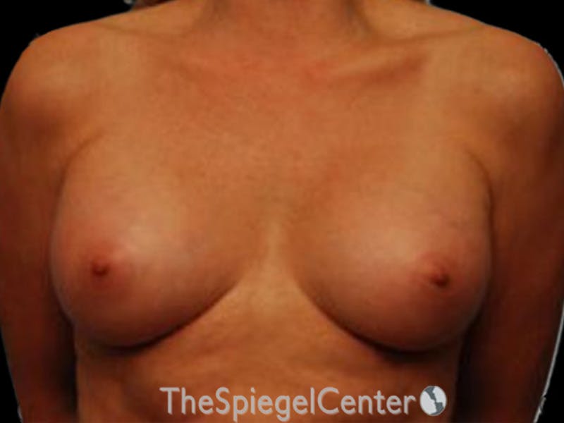 Breast Augmentation Before & After Gallery - Patient 255941 - Image 2