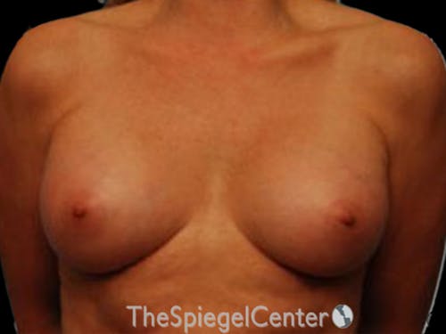 Breast Augmentation Before & After Gallery - Patient 255941 - Image 2