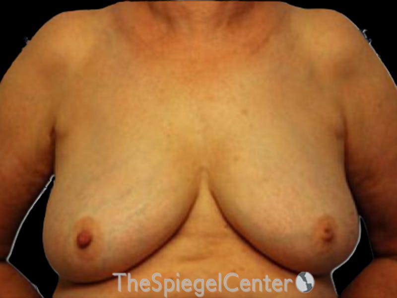 Breast Lift Before & After Gallery - Patient 708174 - Image 1