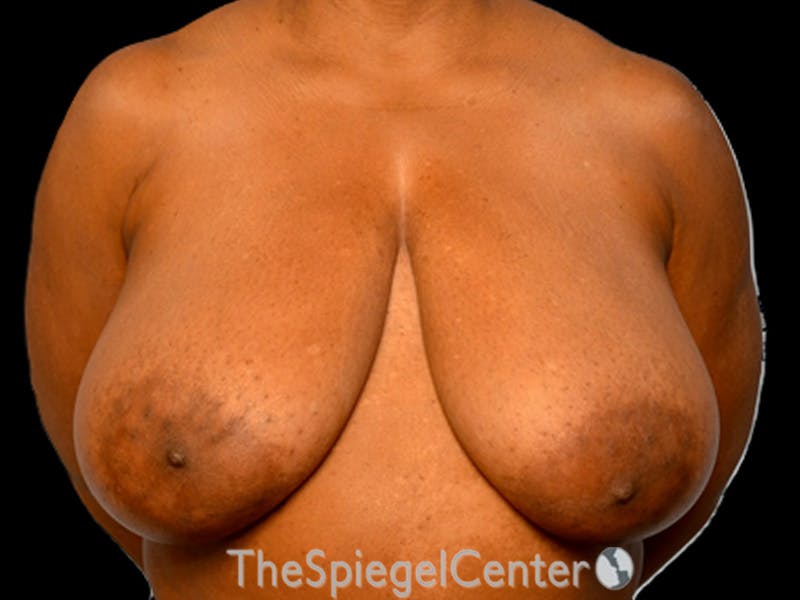 Breast Lift Before & After Gallery - Patient 350780 - Image 1