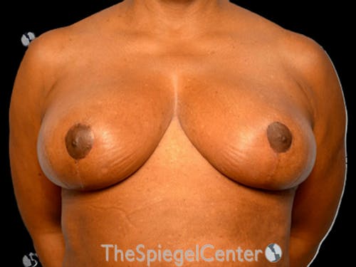 Breast Lift Before & After Gallery - Patient 350780 - Image 2
