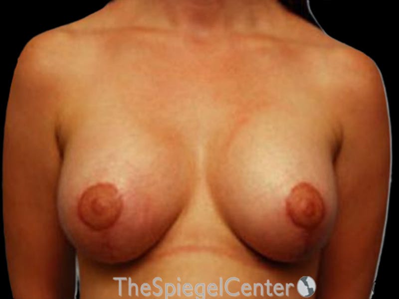 Breast Lift with Augmentation Before & After Gallery - Patient 582123 - Image 2