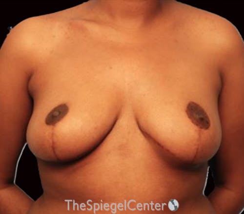 Breast Reduction Before & After Gallery - Patient 214344 - Image 2