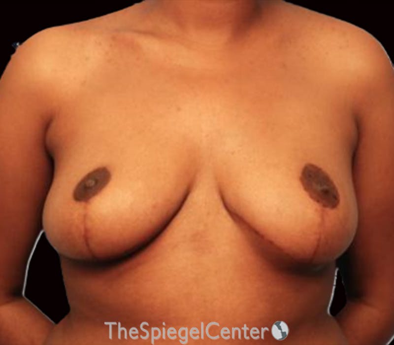 Breast Reduction Before & After Gallery - Patient 214344 - Image 2