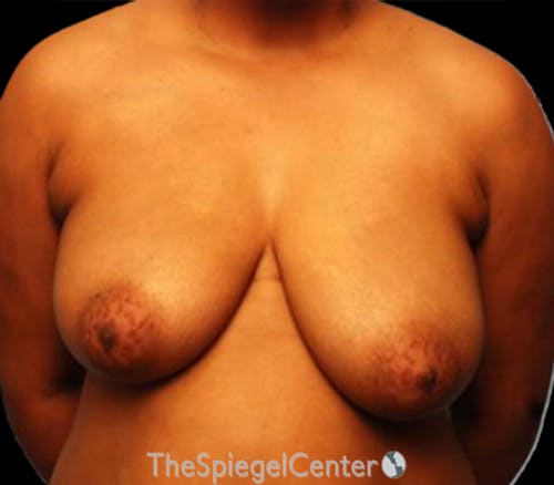 Breast Reduction Before & After Gallery - Patient 477986 - Image 1