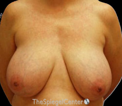 Breast Reduction Before & After Gallery - Patient 290514 - Image 1