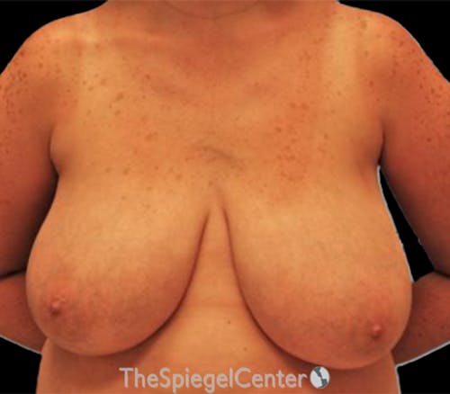 Breast Reduction Before & After Gallery - Patient 729811 - Image 1