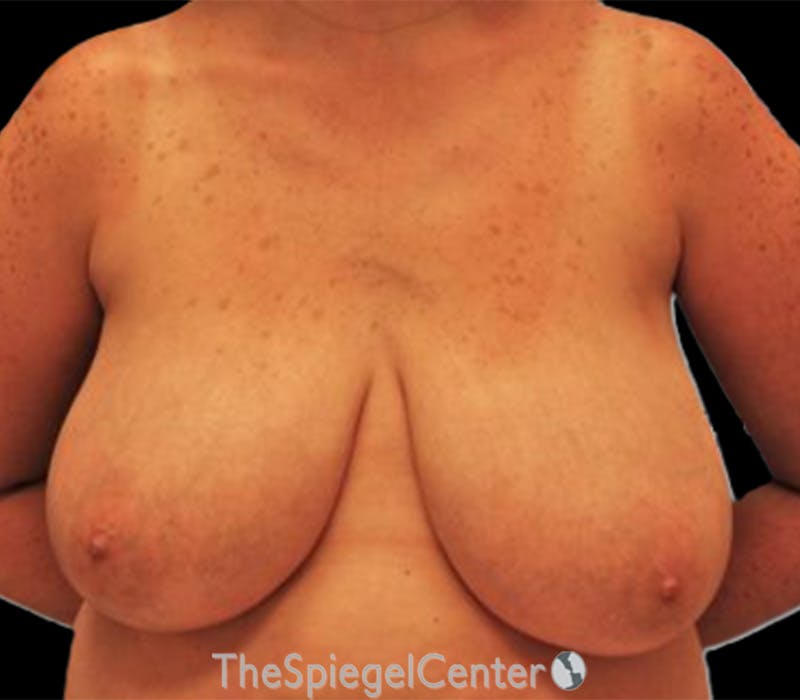 Breast Reduction Before & After Gallery - Patient 729811 - Image 1
