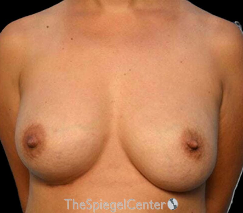 Breast Revision Before & After Gallery - Patient 339203 - Image 2