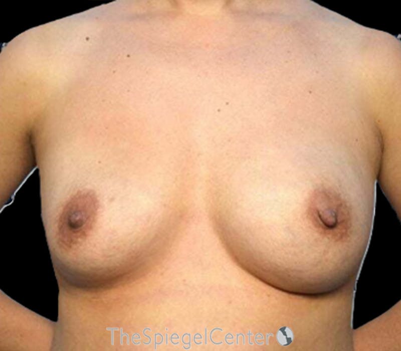 Breast Revision Before & After Gallery - Patient 339203 - Image 1