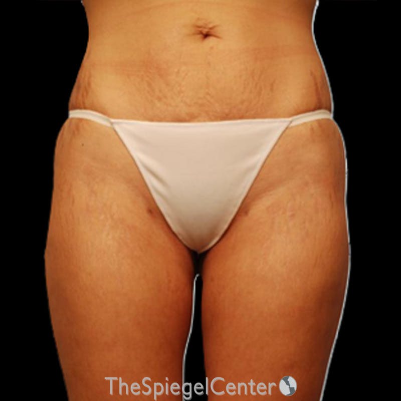 Liposuction Before & After Gallery - Patient 215309 - Image 2