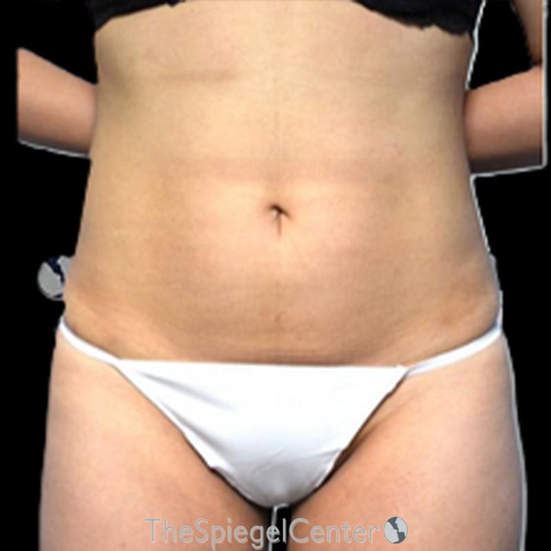 Liposuction Before & After Gallery - Patient 184061 - Image 2