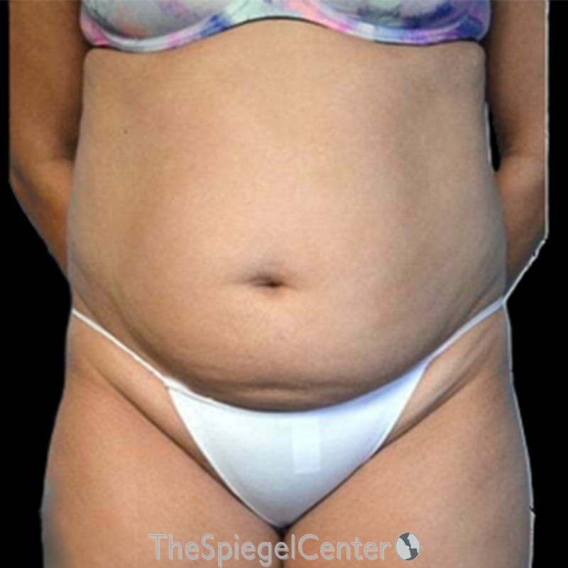 Liposuction Before & After Gallery - Patient 186899 - Image 1