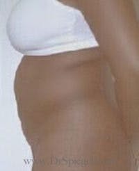 Tummy Tuck Before & After Gallery - Patient 186961 - Image 1