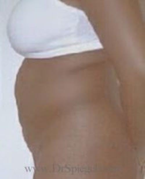 Tummy Tuck Before & After Gallery - Patient 186961 - Image 1