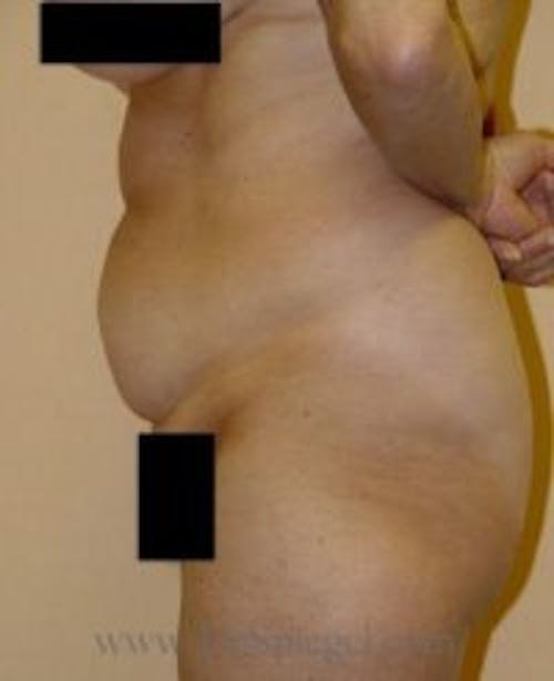 Tummy Tuck Before & After Gallery - Patient 120806 - Image 1