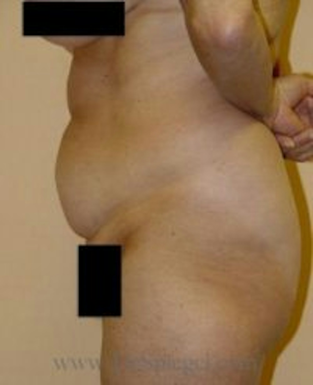 Before and After Photos of a Tummy Tuck in Boston