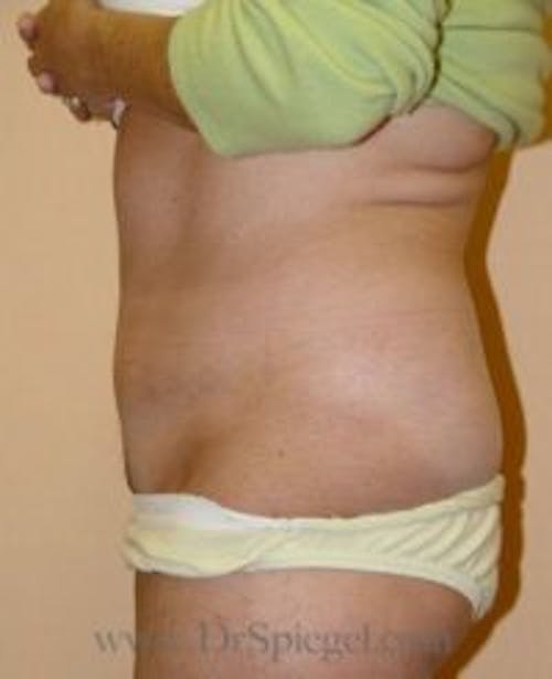 Tummy Tuck Before & After Gallery - Patient 120806 - Image 2