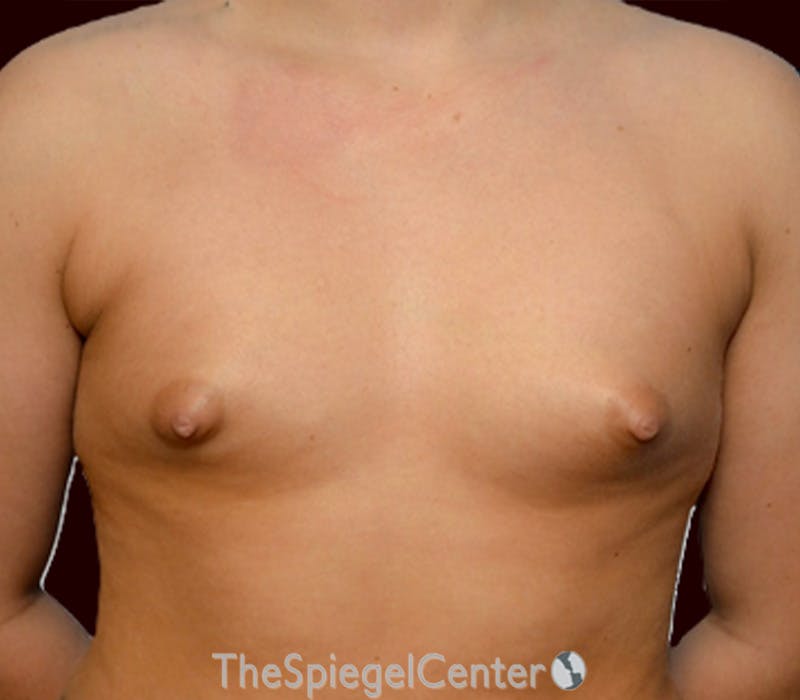 Tubular Breast Correction Before & After Gallery - Patient 226291 - Image 1