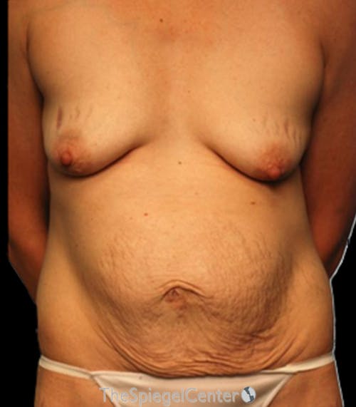 Tummy Tuck Before & After Gallery - Patient 362104 - Image 1
