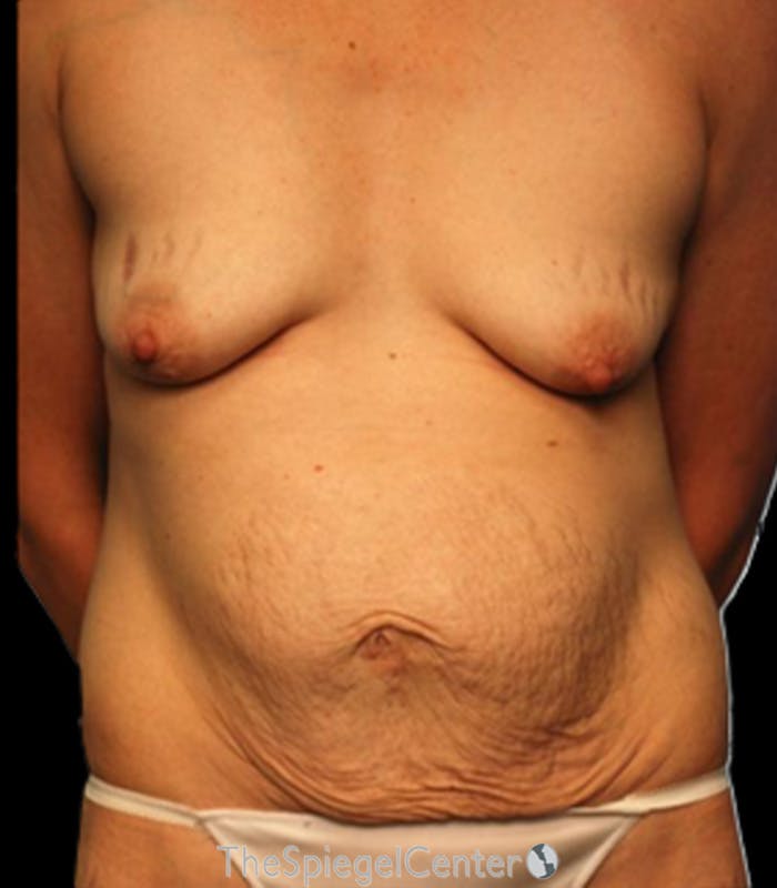Tummy Tuck Before & After Gallery - Patient 362104 - Image 1