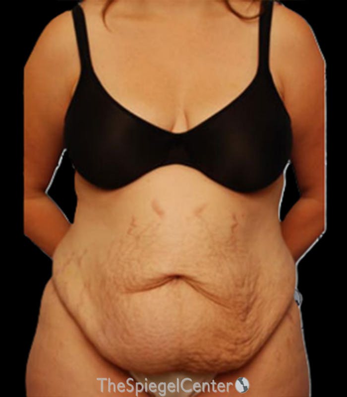Tummy Tuck Before & After Gallery - Patient 152496 - Image 1